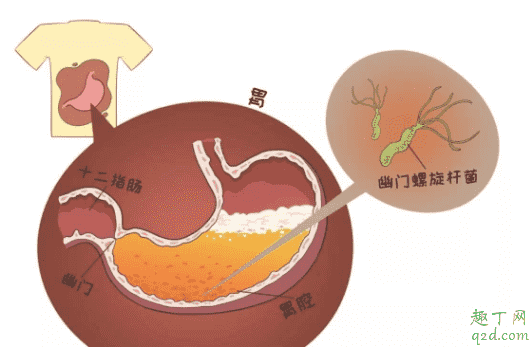 幽門螺桿菌感染會出現哪些癥狀 胃病是因為幽門螺桿菌嗎1